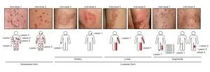 Mosaics of predisposition cause skin disease 2