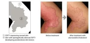Mosaics of predisposition cause skin disease 3