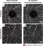 Mount Sinai ophthalmologists develop new technique to assess progression of sickle cell retinopathy