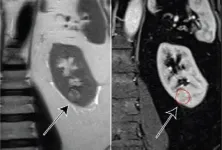 MRI, clear cell likelihood score correlate with renal mass growth rate