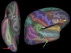 MRI identifies brain abnormalities in chronic fatigue syndrome patients 2