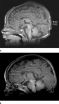 MRI shows brain abnormalities in late preterm infants 2