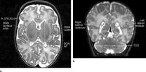 MRI shows brain abnormalities in late preterm infants 3