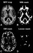 MRI shows gray matter myelin loss strongly related to MS disability 2