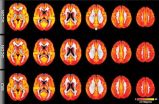 MRI technique detects evidence of cognitive decline before symptoms appear