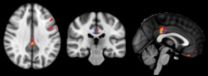 MRI technique detects evidence of cognitive decline before symptoms appear 2