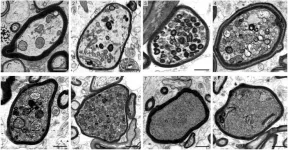 Multiple sclerosis: Myelin may be detrimental to nerve fibres