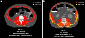 Muscle fat linked to higher mortality risk