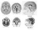 Mutations in single gene may have shaped human cerebral cortex