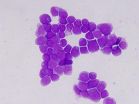 Mutations in single gene predict poor outcomes in adult leukemia