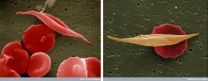 Mystery solved: How sickle hemoglobin protects against malaria