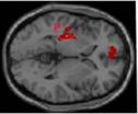 Neuronal activation by acupuncture at Yongquan and sham acupoints for DOC: A PET study