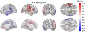 New AI model measures how fast the brain ages