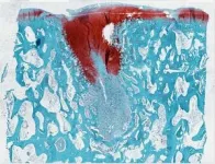 New biomaterial regrows damaged cartilage in joints 3