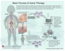 New gene therapy for 'bubble boy' disease appears effective, safe, study in NEJM reports 3