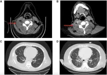 New genetic mutation linked to drug resistance in non-small cell lung cancer patient