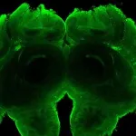 New Huntington’s treatment prevents protein aggregation 2