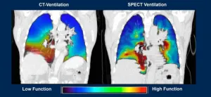 New imaging software improves lung diagnosis for 30% of patients who cant tolerate contrast dye; has added diagnostic benefits for all patients