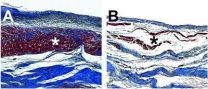 New injectable hydrogel encourages regeneration and improves functionality after a heart attack  