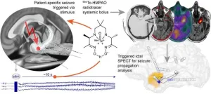 New method for triggering and imaging seizures can help guide epilepsy surgery