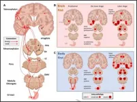 New model may explain the mystery of asymmetry in Parkinsons disease