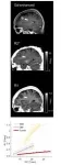 New MRI technology: a non-invasive look at iron balance 3