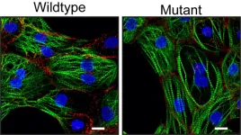 New mutation in the desmoplakin gene leads to ACM