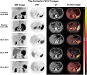 New PET/CT technique accurately diagnoses adrenal gland disorder, informs personalized treatment plans