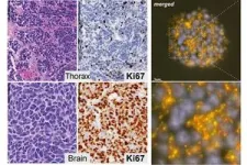 New, rare type of small cell lung cancer identified by MSK research team 2