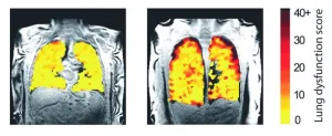 New scan method unveils lung function secrets