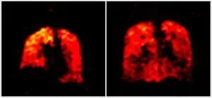 New scan method unveils lung function secrets 2