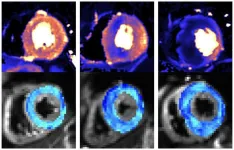 New scanning methods can detect deadly heart condition before symptoms appear