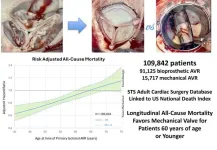 New study finds mechanical valves offer superior long-term survival for aortic valve replacement patients aged 60 and younger