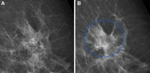 New study sheds light on the role of Wnt/β-catenin signaling in abdominal aortic aneurysm 2