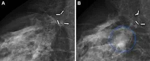 New study sheds light on the role of Wnt/β-catenin signaling in abdominal aortic aneurysm 3