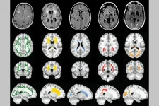 NIH grant funds study of cerebral small vessel disease