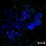 NIH researchers discover new autoinflammatory disease, suggest target for potential treatments