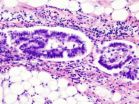 NIH researchers identify novel genes that may drive rare, aggressive form of uterine cancer