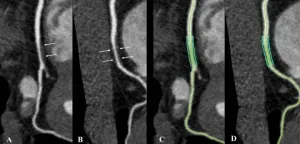 Noncalcified coronary plaque burden higher in people with HIV