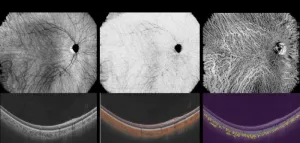 Noninvasive choroidal vessel analysis via deep learning: A new approach to choroidal optical coherence tomography angiography