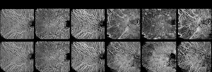 Noninvasive choroidal vessel analysis via deep learning: A new approach to choroidal optical coherence tomography angiography 3