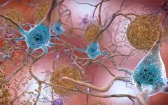 Novel drug prevents amyloid plaques, a hallmark of Alzheimers disease