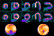 Novel radiotracer demonstrates high diagnostic efficacy for obese patients with coronary artery disease