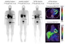 Novel radiotracer produces high quality images of “Alzheimer’s disease of the heart”