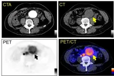 Novel radiotracer shows promise to predict abdominal aortic aneurysm rupture