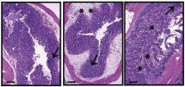 Obesity a liability in cancer immunotherapy 2