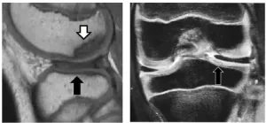 Oh my meniscus: age poses risk of further knee injury in children