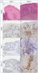 Oncotarget: PD-1/PD-L1 expression in anal squamous intraepithelial lesions