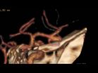 One-third of all brain aneurysms rupture: the size is not a significant risk factor