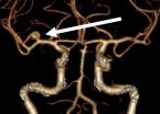 One-third of all brain aneurysms rupture: the size is not a significant risk factor 2